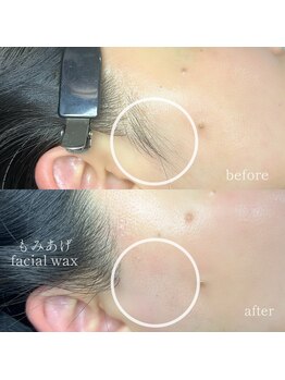 サロン ジュウ(salon Jyuu.)/もみあげワックス脱毛