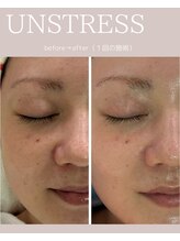 シンスプラス(SINCE+)/乳酸菌ピーリング　アンストレス