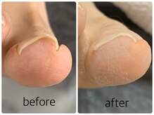 ネイルアンドアイラッシュ アヴィ(Nail and Eyelash A'vi)/巻爪補正