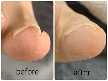 ネイルアンドアイラッシュ アヴィ(Nail and Eyelash A'vi)/巻爪補正