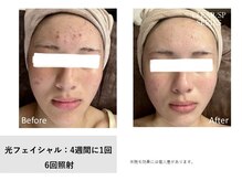 レア(Le'a)/【光フェイシャル】