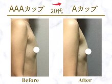 Ms.やまとなでしこ/【ビフォ-アフタ-】AAA→Aカップ