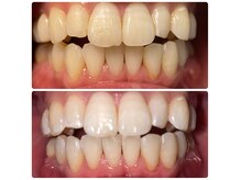 コントレール 歯ぁと(CONTRAIL)の雰囲気（25歳女性。毎週照射、１か月後です。）