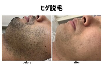 ゴールドプラス 日田店(GOLD PLUS)/ヒゲ脱毛