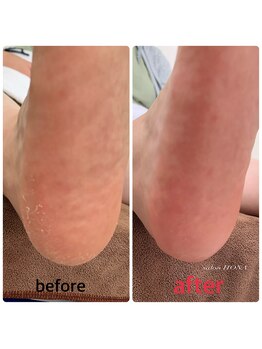 ホナ(HONA)/かかとツルツル