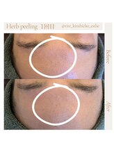 リル 錦糸町店(RiRe)/ハーブピーリング1回BeforeAfter