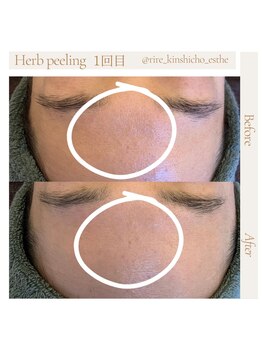 リル 錦糸町店(RiRe)/ハーブピーリング1回BeforeAfter