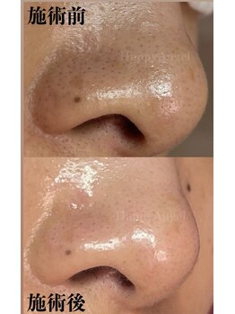 ハッピーエンジェル(Happy Angel)/SNSで話題の毛穴改善