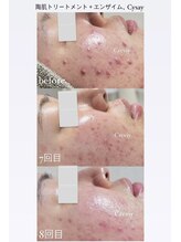 クレヴィー(Creviy)/肌荒れ改善ハーブピーリング