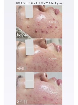 クレヴィー(Creviy)/肌荒れ改善ハーブピーリング