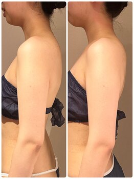 グリーミン 代々木(gleaming)/姿勢矯正は巻き肩を矯正します