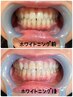 《黄ばみの悩みケア》歯のホワイトニング☆☆1回15分2回照射　特別価格￥3500
