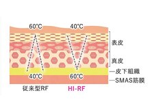 体温上昇による基礎代謝アップ【最新型ラジオ波HI-RFによる深部加熱】