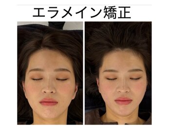 エレヴィザ トウキョウ 恵比寿院(ELVISA TOKYO)/エラ・フェイスラインの大き改善