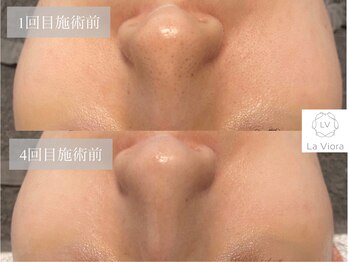 ラヴィオーラ 姫路店(La Viora)/ダイヤモンドハーブピーリング