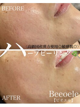 ビオエル(Bee'oele)/高級国産ハーブピーリング