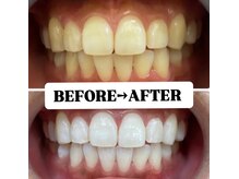 ホワイトニングサロン 豊中/Before&After美白ホワイトニング