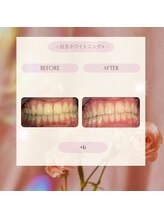 プラスビー 2号店(+b)/ホワイトニングビフォーアフター