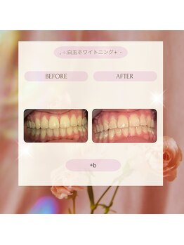 プラスビー 2号店(+b)/ホワイトニングビフォーアフター