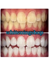 セルフホワイトニング専門店　 ホワイトニングショップ船橋2号店【ホワイトニング】/Before&After美白ホワイトニング