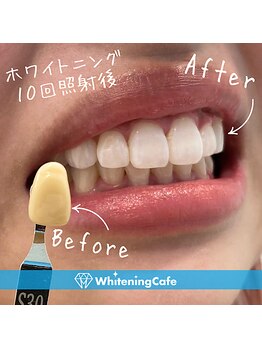 ホワイトニングカフェ 池袋東口店/ホワイトニングビフォーアフター