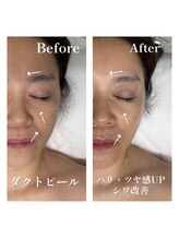 モア(MOA)/ダクトピールでシワ改善★