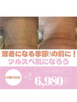 プリトリート(Pritreat)の写真/【気になる首のブツブツに】夏までにスッキリ綺麗に/首orボディコース