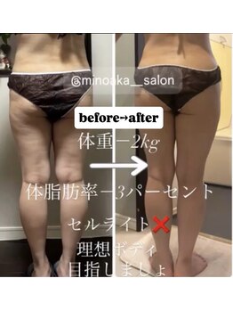 ヨサパーク ミノアカ(YOSA PARK MINOAKA)/驚きの変化ー下半身セルライト