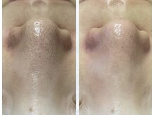 アネル 美里店(anel)/最新のハイドロで毛穴ケア