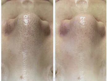 アネル 美里店(anel)/最新のハイドロで毛穴ケア