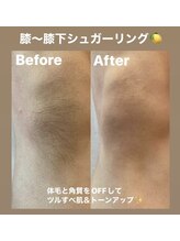 ララルアナ(Lara luana)/脱毛×角質ケアで美肌