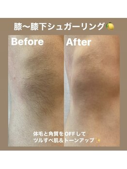 ララルアナ(Lara luana)/脱毛×角質ケアで美肌