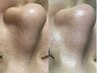 【毛穴ケアが初めての方に】［鼻のみ］深層ピーリング×最新毛穴洗浄　¥9,800