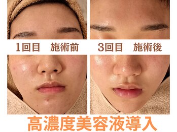 エリン(ERIN)/毛穴徹底洗浄×高濃度美容液導入