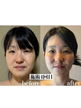 語 かたりべ/エステ　ビフォー・アフター