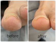 ネイルアンドアイラッシュ アヴィ(Nail and Eyelash A'vi)/巻爪補正