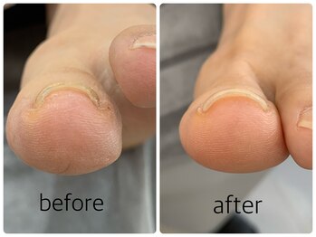 ネイルアンドアイラッシュ アヴィ(Nail and Eyelash A'vi)/巻爪補正