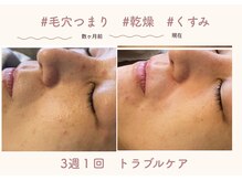 オートクチュール エステティックサロン シーズ/★定期的なお手入れで肌質改善★