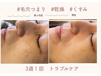 オートクチュール エステティックサロン シーズ/★定期的なお手入れで肌質改善★