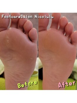 ニコルル 春日部店(Nicolulu)/魚の目ビフォーアフター