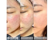 ビズエー(viz.A)/ピーリング＋フェイスワックス