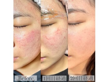 ビズエー(viz.A)/ピーリング+フェイスワックス