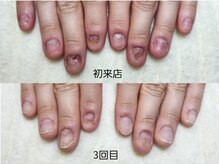 深爪矯正 爪悩み専門店 グラシナ 西宮北口店【4/3 NEW OPEN（予定）】/(深爪/長さだし/フィルイン)