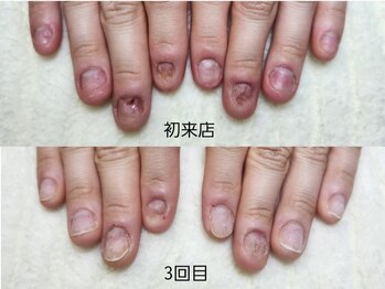 深爪矯正 爪悩み専門店 グラシナ 西宮北口店【4/3 NEW OPEN（予定）】/(深爪/長さだし/フィルイン)