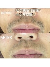ココ(Coco)/ヒゲ脱毛12回：ビフォーアフター