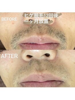 ココ(Coco)/ヒゲ脱毛12回：ビフォーアフター