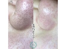 アンク(Ankh)/毛穴どこいった？黒ずみ撃退！