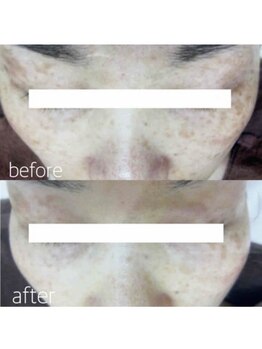 ブランシェ 高岡店 × 椿/シミケア　お客様