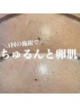 ルアナマナ(Luana Mana)/陶肌トリートメント