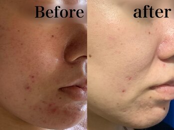 ヒール(heal)/症例